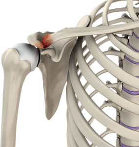 Ac Joint Pain Shoulder