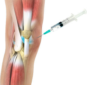 viscosupplementation