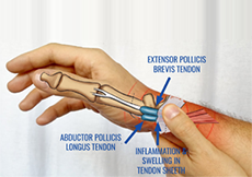 De Quervain Tendinopathy