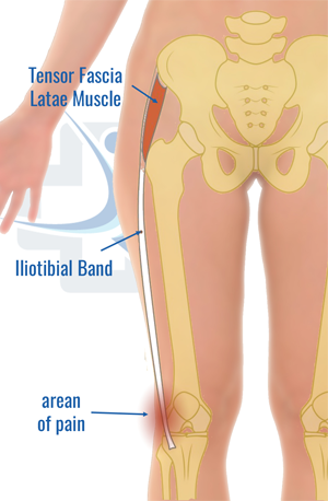 Iliotibial Band (ITB) Friction Syndrome