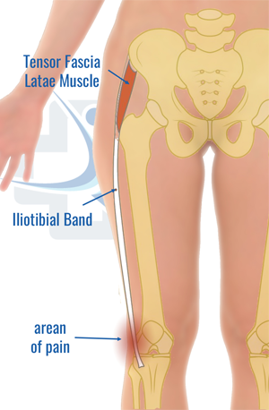 IT Bands and Hip Bursitis