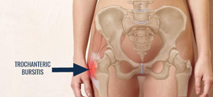 Treatment For Hip Bursitis and Causes Melbourne