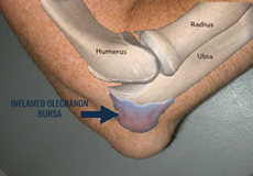 Elbow Bursitis