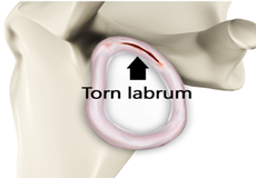 Shoulder Labrum Tear