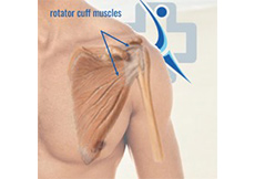 Rotator Cuff Tear