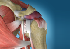 Shoulder bursitis / Impingement